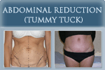 Tummy Tuck - Photo